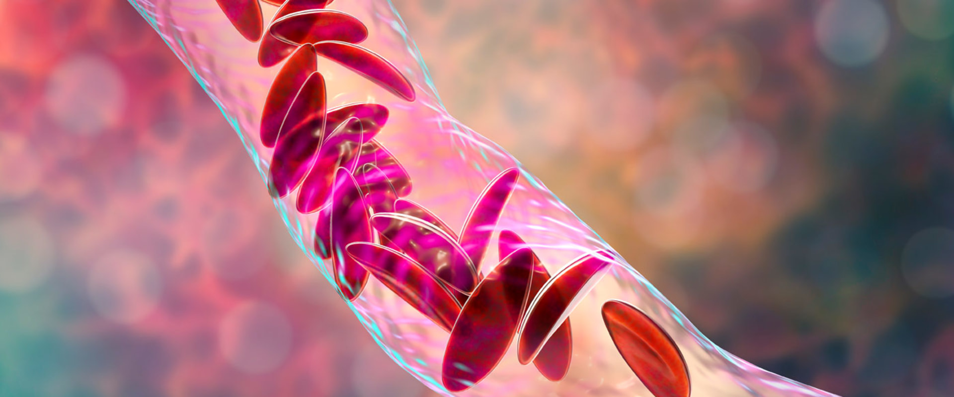 Difference Between Sickle Cell Anemia and Sickle Cell Disease: Inside the Genetics and Treatments You Should Understand