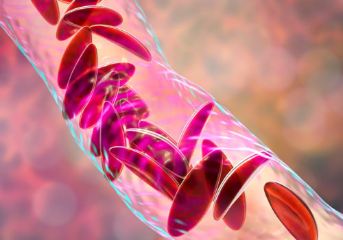 Difference Between Sickle Cell Anemia and Sickle Cell Disease: Inside the Genetics and Treatments You Should Understand